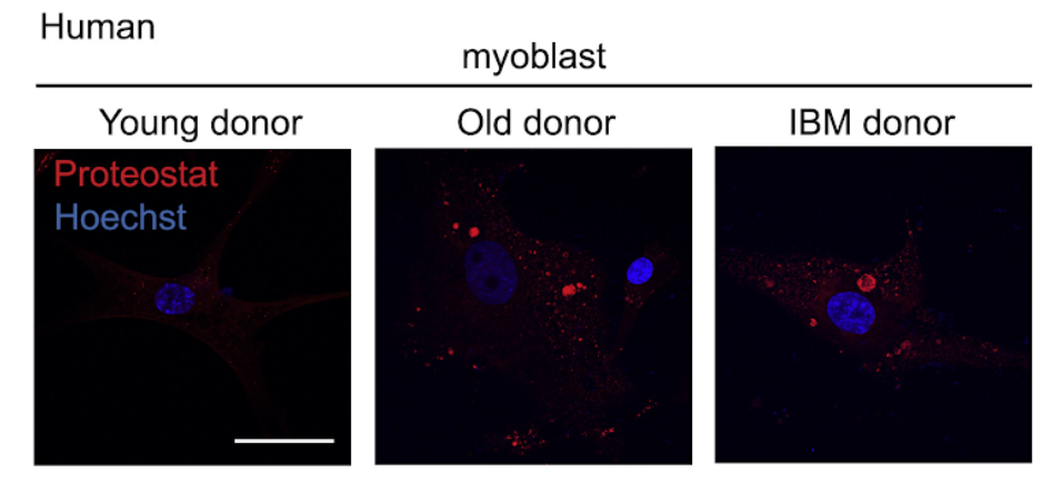Accumulation of amyloid-like deposits in aging and IBD human muscle cells.